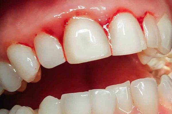 Tratamento periodontal