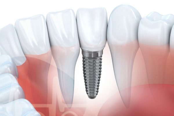 implantes-dentarios